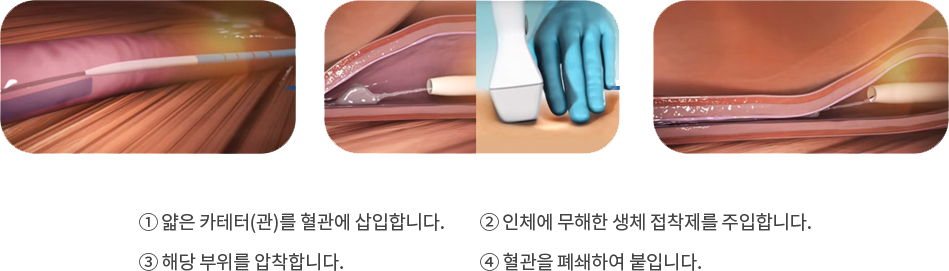 ① 얇은 카테터(관)를 혈관에 삽입합니다. ② 인체에 무해한 생체 접착제를 주입합니다. ③ 해당 부위를 압착합니다. ④ 혈관을 폐쇄하여 붙입니다.